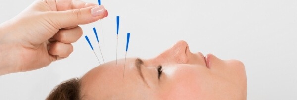 Châm cứu – một trong những phương pháp điều trị đau đầu nhiều ngày được nhiều người lựa chọn