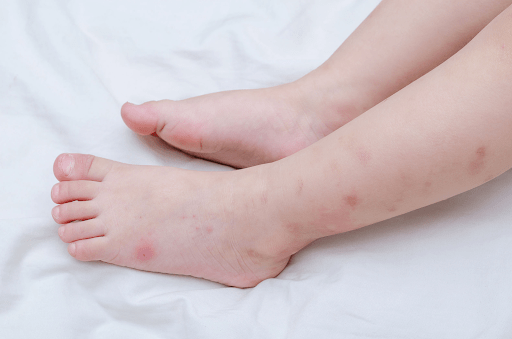 Phát ban là giai đoạn nguy hiểm của sốt xuất huyết