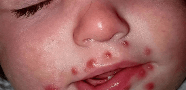 vết loét trên miệng trẻ bị tay chân miệng