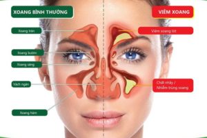 viêm xoang gây sổ mũi
