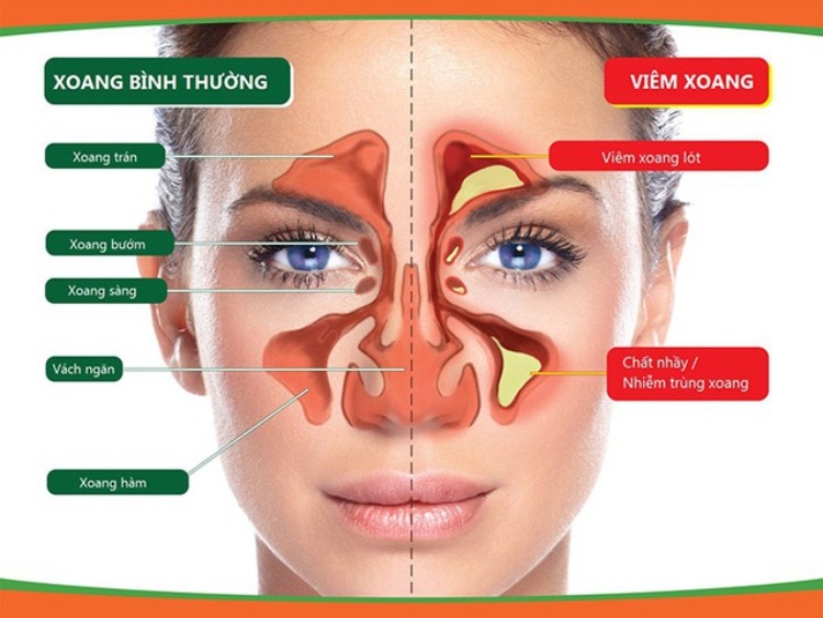 Viêm xoang xảy ra khi các xoang xung quanh mũi bị viêm