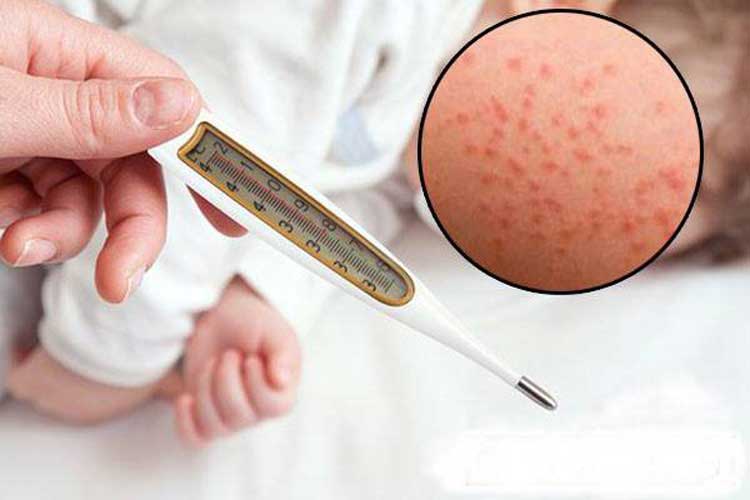 Dựa vào các dấu hiệu và triệu chứng để chẩn đoán bệnh sởi