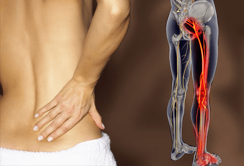 Đau thần kinh toạ sẽ có các triệu chứng giống như đau cơ mông