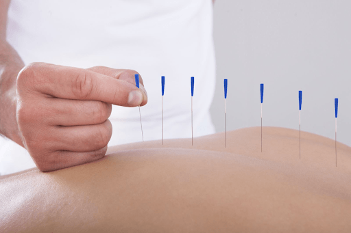 giảm đau hiệu quả bằng châm cứu