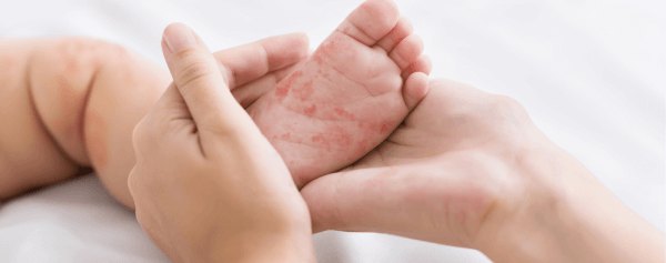 phân biệt sởi với bệnh khác