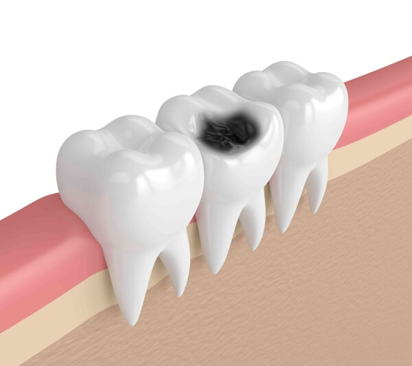 Những tác hại khi trẻ bị sâu răng hàm 