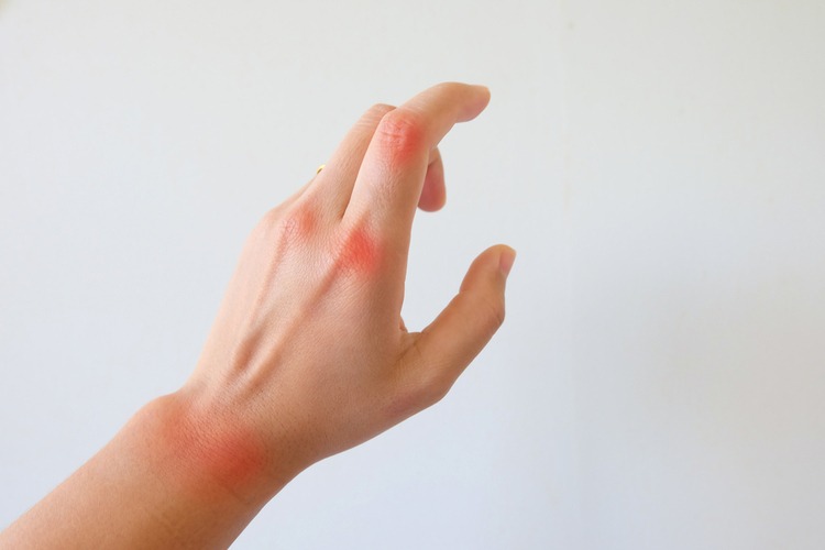 viêm khớp xảy ra ở các khớp bị viêm