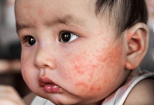 thắc mắc bệnh sởi