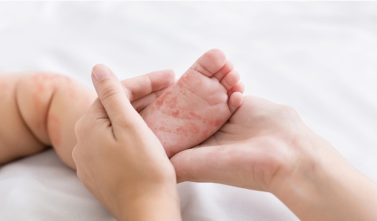 bệnh sởi ở trẻ nhỏ