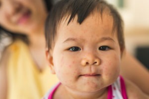 bệnh sởi và những thắc mắc
