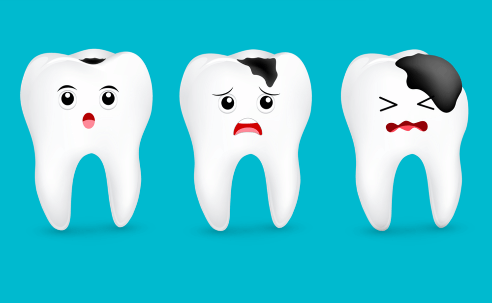 Điều trị tình trạng trẻ bị sâu răng hàm