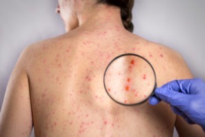 giải đáp thắc mắc bệnh sởi