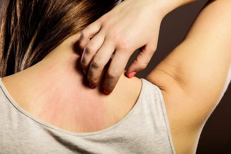 Thắc mắc về bệnh sởi có ngứa không