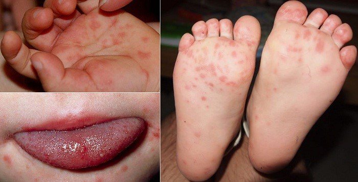 Biểu hiện bệnh chân tay miệng