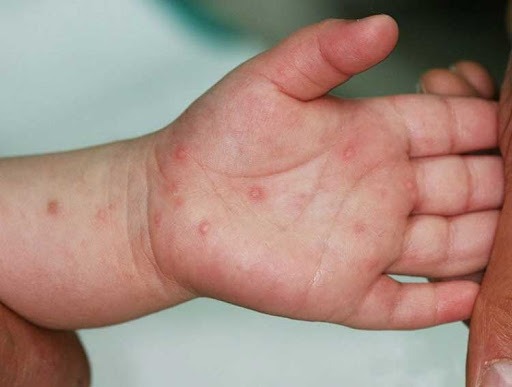 Hình ảnh trẻ bị tay chân miệng biểu hiện các nốt phát ban có thể kèm theo bọng nước