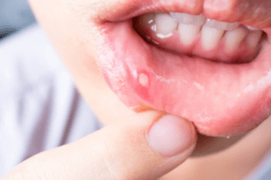loét miệng dấu hiệu trẻ mắc tay chân miệng