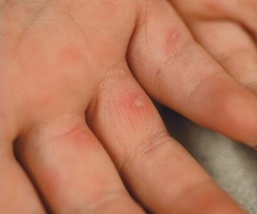 Hình ảnh trẻ bị chân tay miệng với nốt phát ban trên bàn tay
