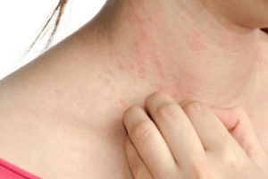 Sốt xuất huyết bị ngứa là dấu hiệu cho thấy bệnh nhân đang hồi phục.