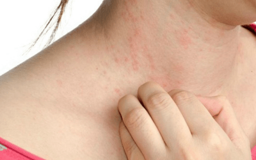 Sốt xuất huyết bị ngứa là dấu hiệu cho thấy bệnh nhân đang hồi phục.