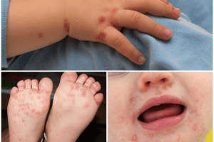 Bệnh tay chân miệng rất dễ lây lan