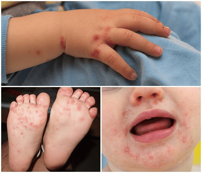 Bệnh tay chân miệng rất dễ lây lan