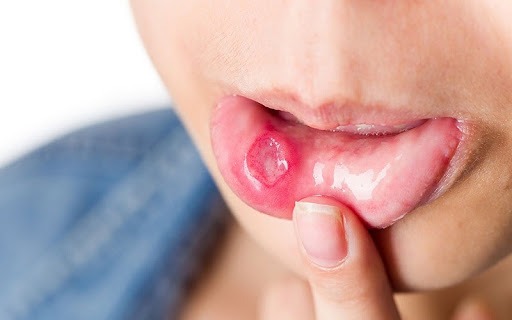 Hình ảnh bé bị tay chân miệng với vết loét ở miệng