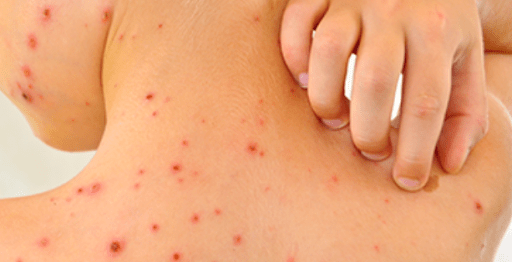 Sốt xuất huyết nhẹ gây mổi mẩn, phát ban
