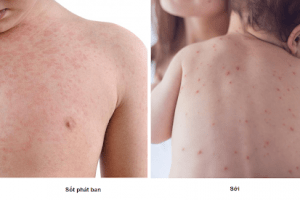 Do có triệu chứng khá giống nhau nên không ít bố mẹ nhầm lẫn giữa sốt phát ban thông thường và sởi.