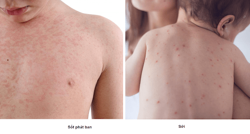 Do có triệu chứng khá giống nhau nên không ít bố mẹ nhầm lẫn giữa sốt phát ban thông thường và sởi.