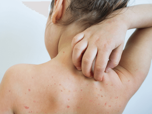 Các nốt ban của sởi rất dễ nhầm lẫn với vết ban do sốt phát ban thông thường gây ra.
