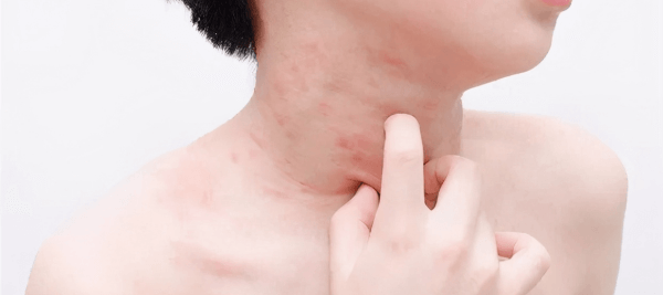Sốt phát ban là bệnh rất thường xảy ra ở trẻ nhỏ 