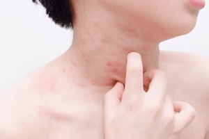 Trẻ sốt phát ban có thể kèm theo ngứa hoặc không.