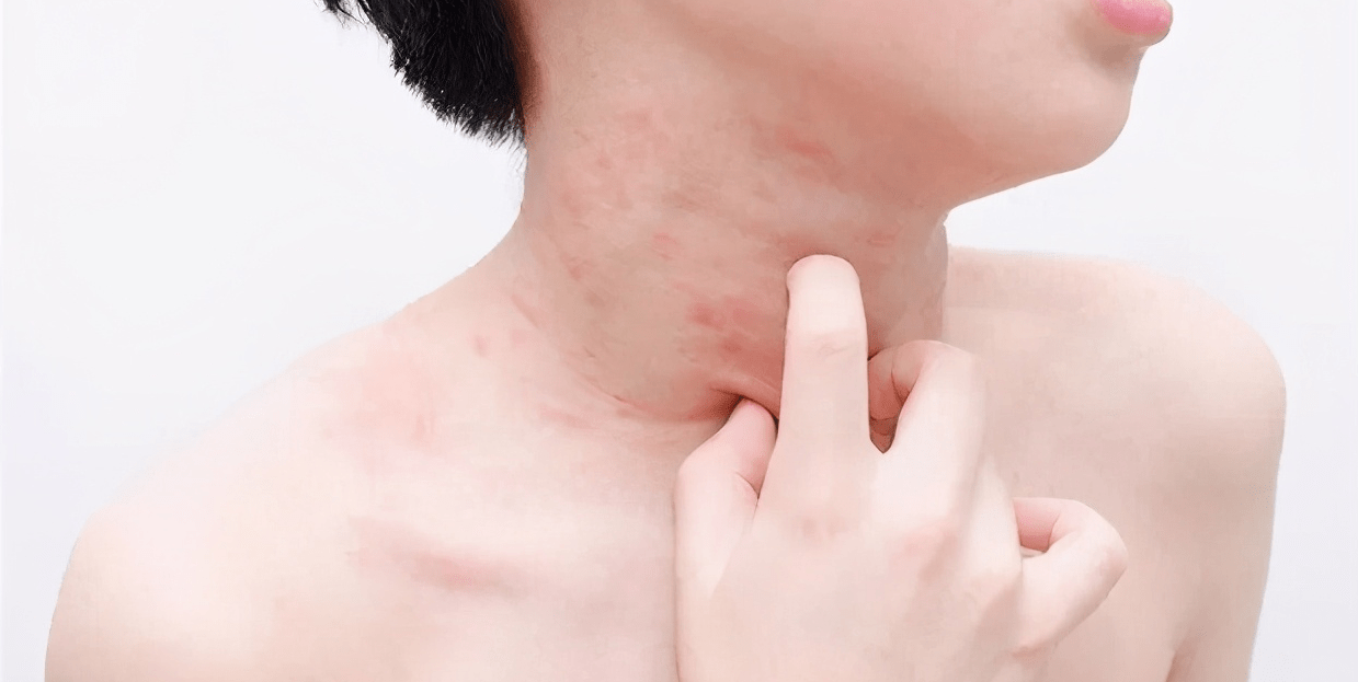 Trẻ sốt phát ban có thể kèm theo ngứa hoặc không.
