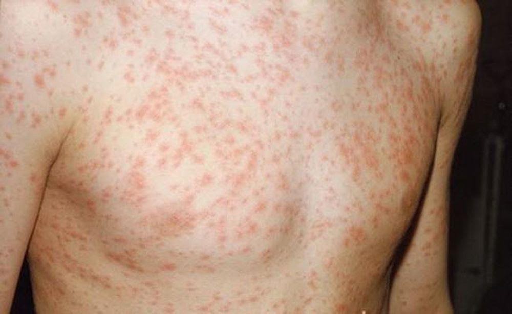 Sốt phát ban biểu hiện đặc trưng là sốt cao kèm phát ban mau đỏ