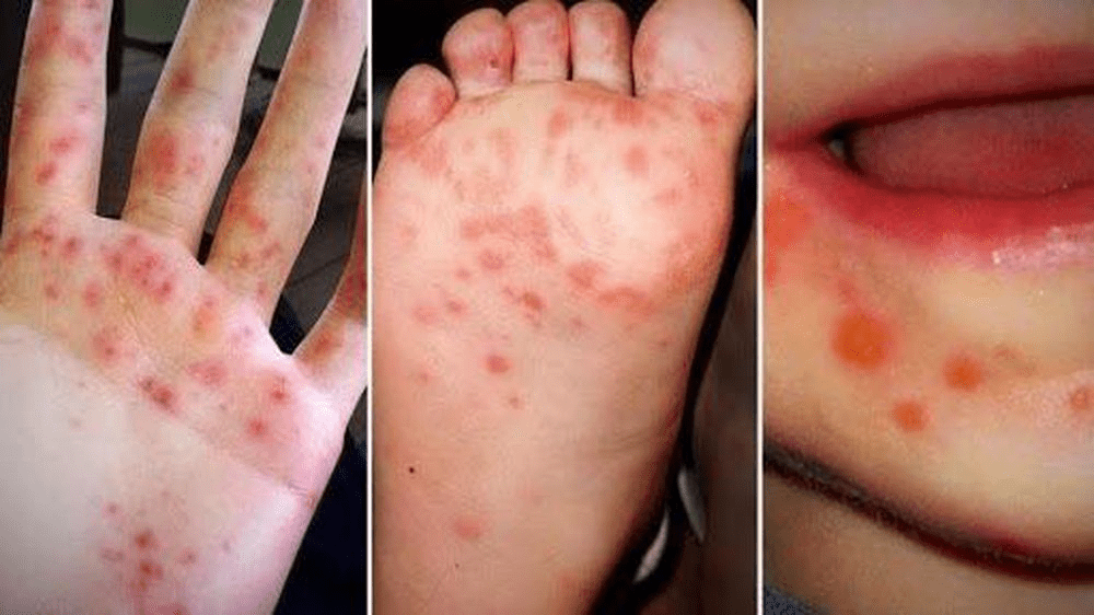 Hình ảnh khi bé bị bệnh tay chân miệng