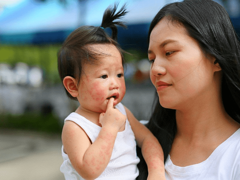 Bệnh tay chân miệng là bệnh phổ biến và thường gặp ở trẻ nhỏ