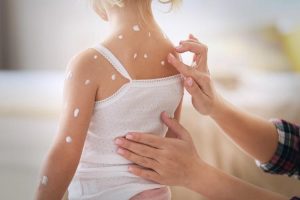 Nổi các nốt mụn nước là triệu chứng dễ biết nhất của bệnh thủy đậu