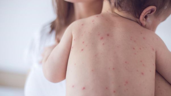 Những lưu ý khi chăm sóc bệnh thủy đậu ở trẻ