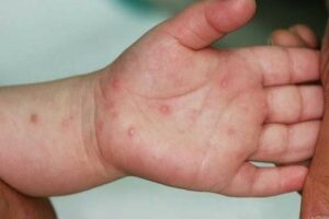 Dấu hiệu của bệnh tay chân miệng