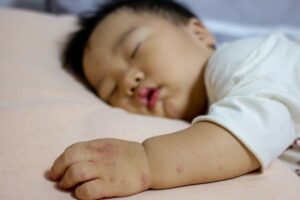 Tay chân miệng làm bé bị sốt và phát ban