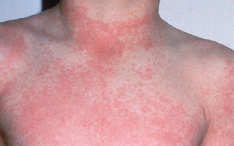 Sốt siêu vi có lây không
