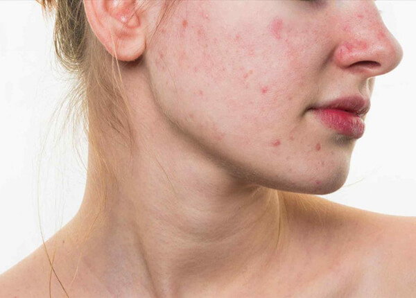 Biến chứng sốt phát ban ở người lớn