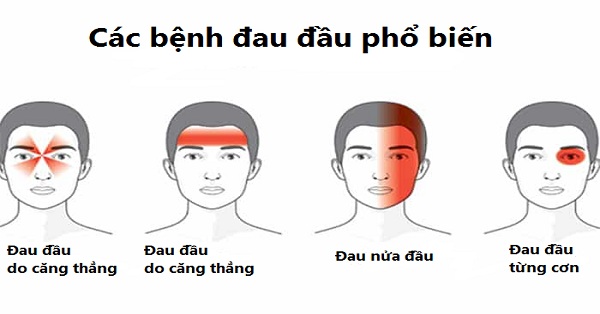 Triệu chứng đau nửa đầu dễ dàng nhận biết
