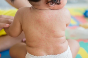 Sốt siêu vi phát ban ở trẻ 