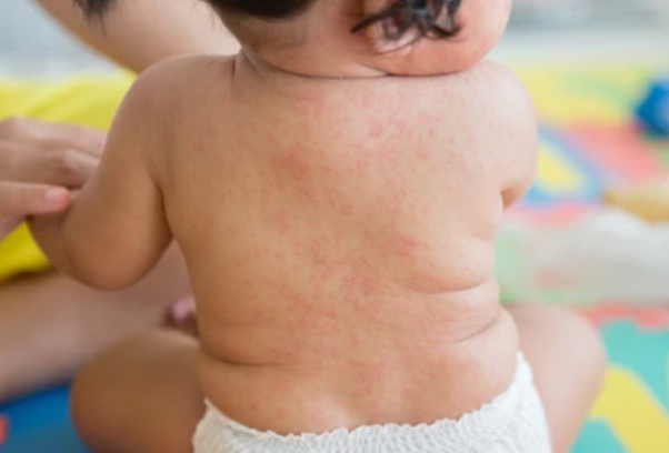 Sốt siêu vi có phát ban không