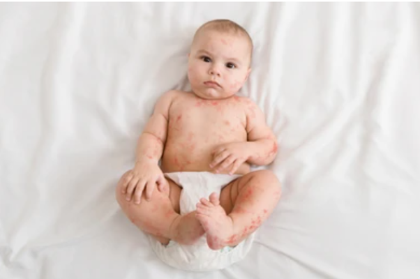 Sốt siêu vi gây nốt đỏ trên cơ thể trẻ nhỏ