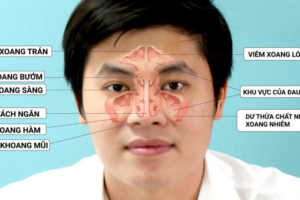 Viêm đa xoang có nhiều nguyên nhân gây nên 