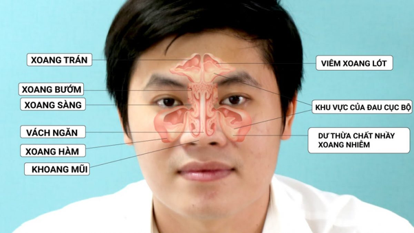 Viêm đa xoang có nhiều nguyên nhân gây nên