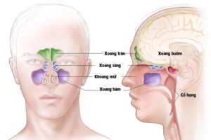 Viêm xoang mãn tính gồm những loại nào 