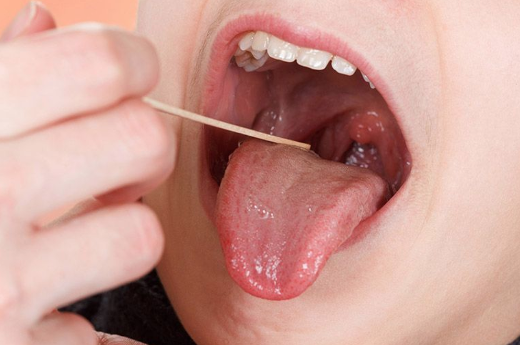viêm họng hạt có mủ 2